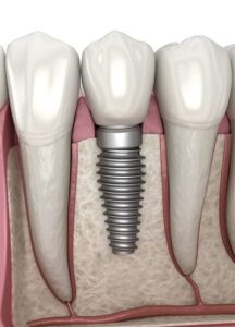 ease dentist dental implant